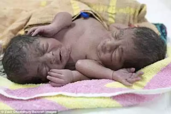 Photos: Conjoined twins with two heads, four hands and two feet dumped by parents